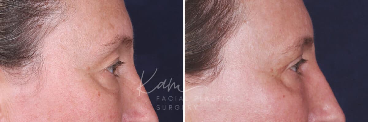 Upper Blepharoplasty before and after photos in Voorhees, NJ, Patient 601