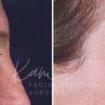 Upper Blepharoplasty before and after photos in Voorhees, NJ, Patient 601