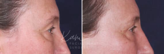 Upper Blepharoplasty before and after photos in Voorhees, NJ, Patient 601
