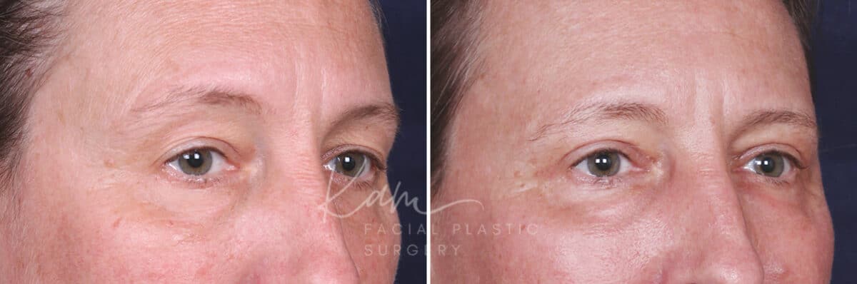 Upper Blepharoplasty before and after photos in Voorhees, NJ, Patient 601
