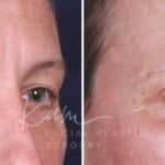 Upper Blepharoplasty before and after photos in Voorhees, NJ, Patient 601