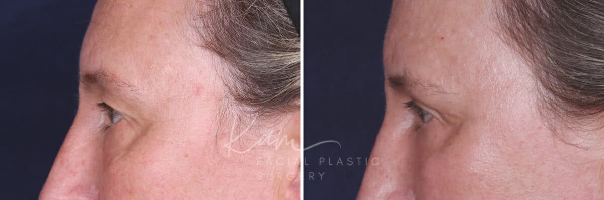 Upper Blepharoplasty before and after photos in Voorhees, NJ, Patient 601