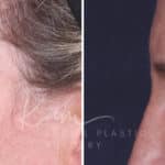 Upper Blepharoplasty before and after photos in Voorhees, NJ, Patient 601