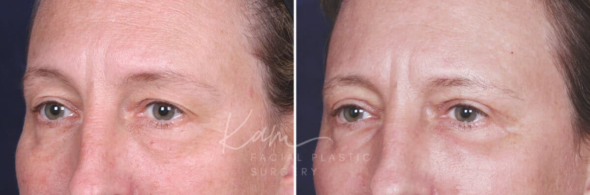 Upper Blepharoplasty before and after photos in Voorhees, NJ, Patient 601