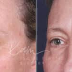 Upper Blepharoplasty before and after photos in Voorhees, NJ, Patient 601