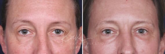 Upper Blepharoplasty before and after photos in Voorhees, NJ, Patient 601