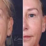 Otoplasty before and after photos in Voorhees, NJ, Patient 617