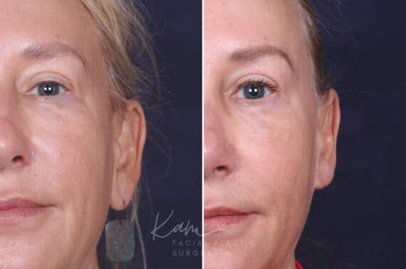 Otoplasty before and after photos in Voorhees, NJ, Patient 617