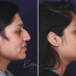 Rhinoplasty before and after photos in Voorhees, NJ, Patient 631