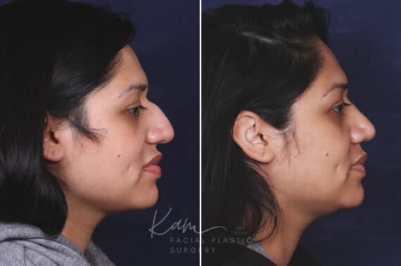 Rhinoplasty before and after photos in Voorhees, NJ, Patient 631