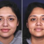 Rhinoplasty before and after photos in Voorhees, NJ, Patient 631