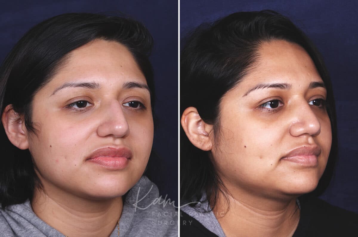 Rhinoplasty before and after photos in Voorhees, NJ, Patient 631