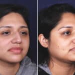 Rhinoplasty before and after photos in Voorhees, NJ, Patient 631