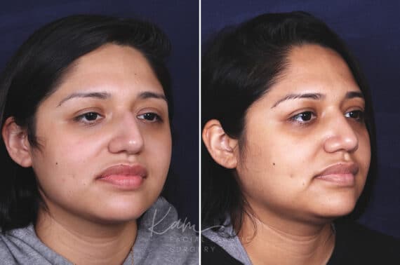 Rhinoplasty before and after photos in Voorhees, NJ, Patient 631