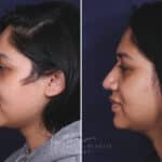 Rhinoplasty before and after photos in Voorhees, NJ, Patient 631