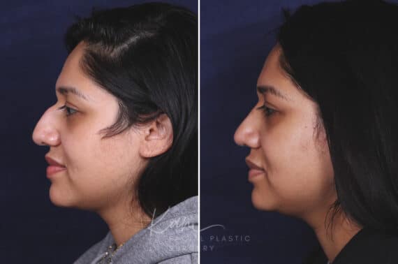 Rhinoplasty before and after photos in Voorhees, NJ, Patient 631