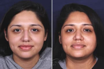 Rhinoplasty before and after photos in Voorhees, NJ, Patient 631