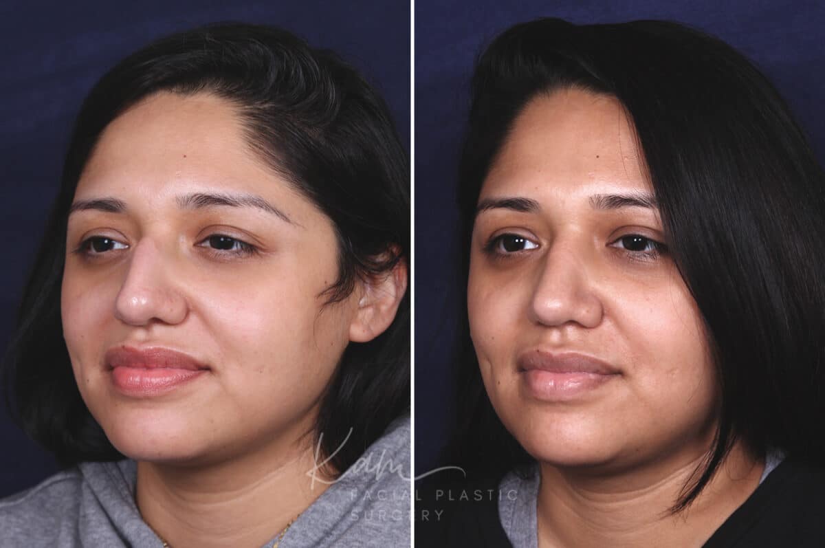 Rhinoplasty before and after photos in Voorhees, NJ, Patient 631
