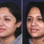 Rhinoplasty before and after photos in Voorhees, NJ, Patient 631