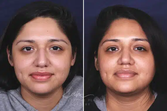 Rhinoplasty before and after photos in Voorhees, NJ, Patient 631