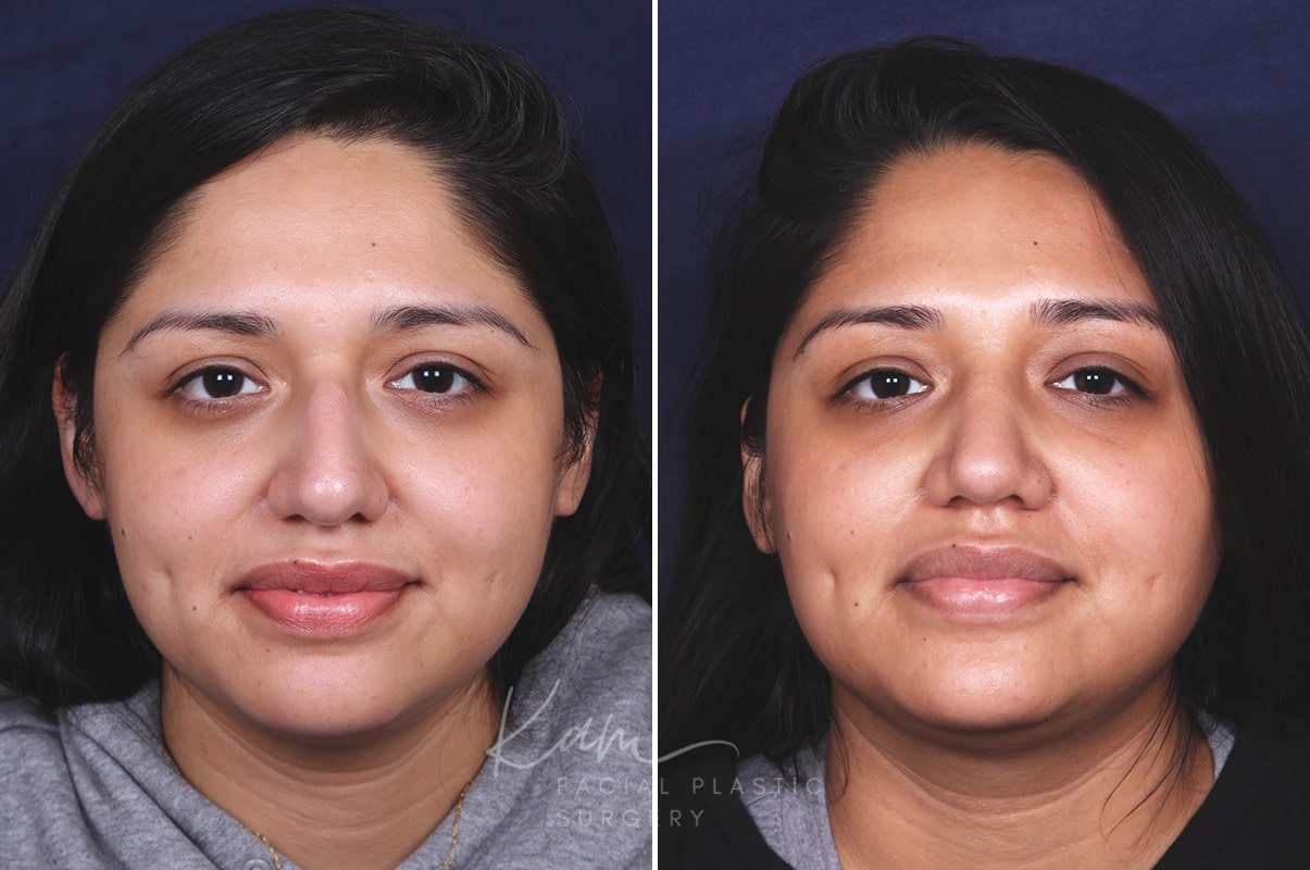 Preventing Visible Scars Before and After Rhinoplasty | New Jersey