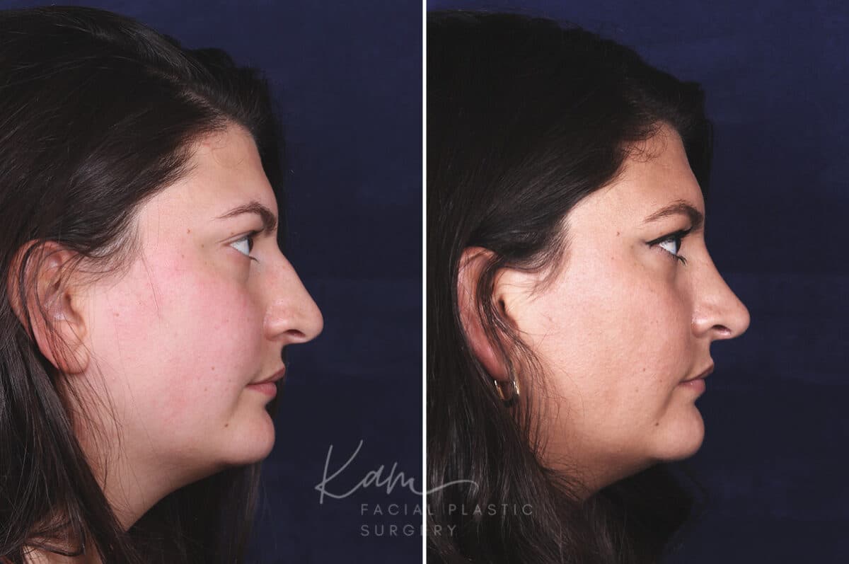 Rhinoplasty before and after photos in Voorhees, NJ, Patient 650