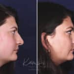 Rhinoplasty before and after photos in Voorhees, NJ, Patient 650