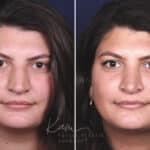 Rhinoplasty before and after photos in Voorhees, NJ, Patient 650