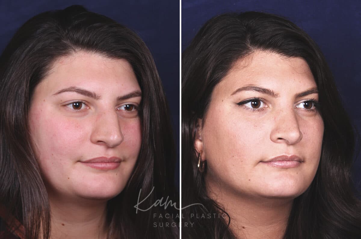 Rhinoplasty before and after photos in Voorhees, NJ, Patient 650