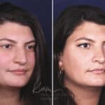 Rhinoplasty before and after photos in Voorhees, NJ, Patient 650