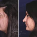 Rhinoplasty before and after photos in Voorhees, NJ, Patient 650