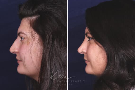 Rhinoplasty before and after photos in Voorhees, NJ, Patient 650