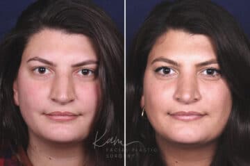 Rhinoplasty before and after photos in Voorhees, NJ, Patient 650