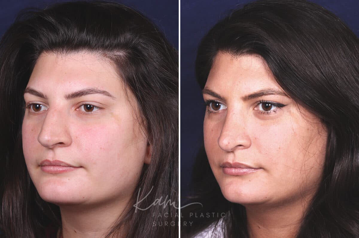 Rhinoplasty before and after photos in Voorhees, NJ, Patient 650