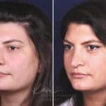 Rhinoplasty before and after photos in Voorhees, NJ, Patient 650