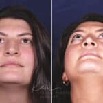 Rhinoplasty before and after photos in Voorhees, NJ, Patient 650