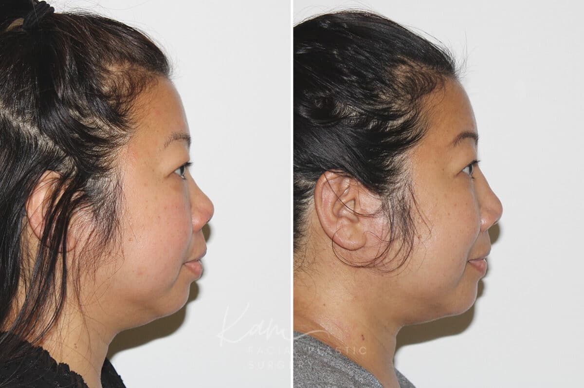 Submental Liposuction before and after photos in Voorhees, NJ, Patient 671