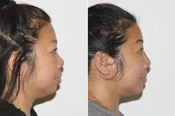 Submental Liposuction before and after photos in Voorhees, NJ, Patient 671
