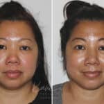 Submental Liposuction before and after photos in Voorhees, NJ, Patient 671