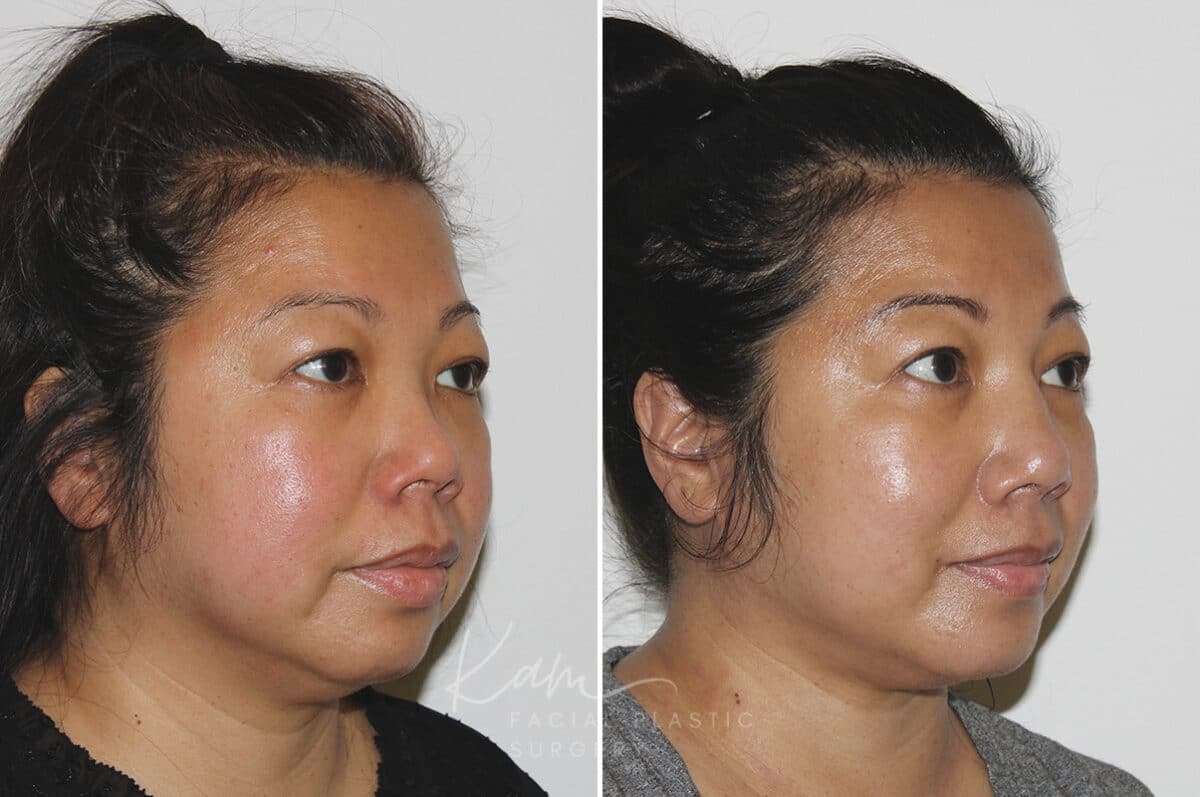 Submental Liposuction before and after photos in Voorhees, NJ, Patient 671