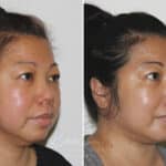Submental Liposuction before and after photos in Voorhees, NJ, Patient 671