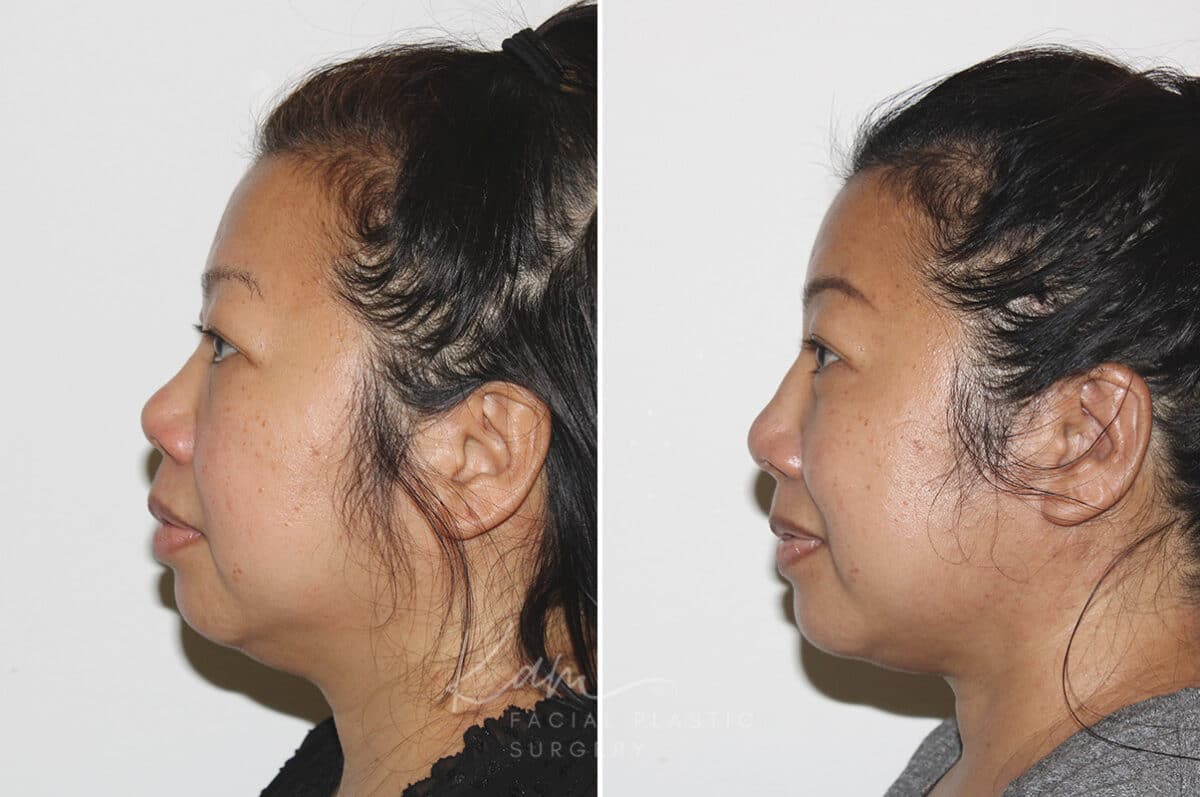 Submental Liposuction before and after photos in Voorhees, NJ, Patient 671