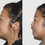 Submental Liposuction before and after photos in Voorhees, NJ, Patient 671