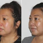 Submental Liposuction before and after photos in Voorhees, NJ, Patient 671