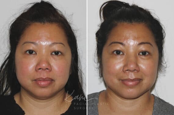 Submental Liposuction before and after photos in Voorhees, NJ, Patient 671