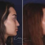 Rhinoplasty before and after photos in Voorhees, NJ, Patient 91
