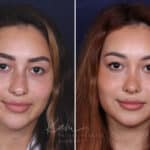 Rhinoplasty before and after photos in Voorhees, NJ, Patient 91