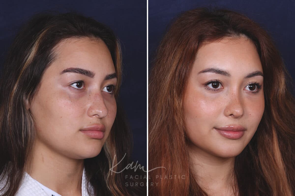 Rhinoplasty before and after photos in Voorhees, NJ, Patient 91