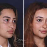 Rhinoplasty before and after photos in Voorhees, NJ, Patient 91