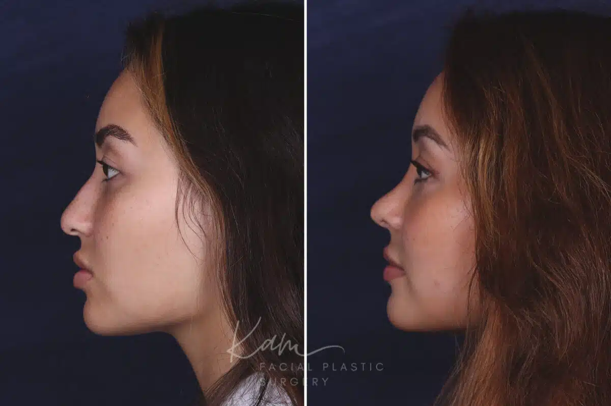 Rhinoplasty before and after photos in Voorhees, NJ, Patient 91